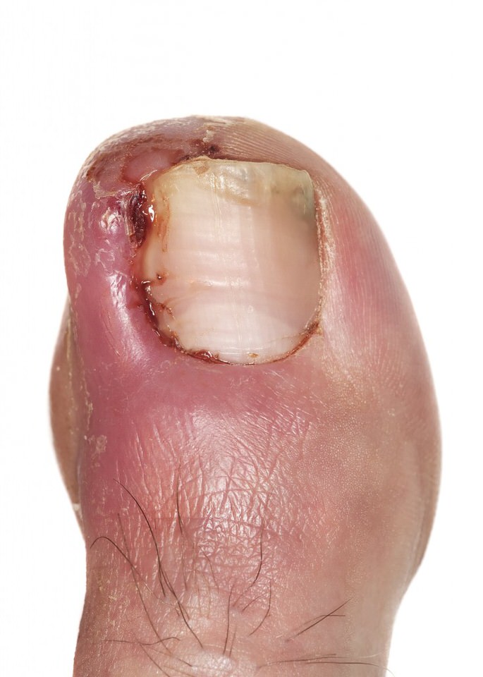 Nail surgery for Painful & Ingrowing Toenails - Evolution Podiatry