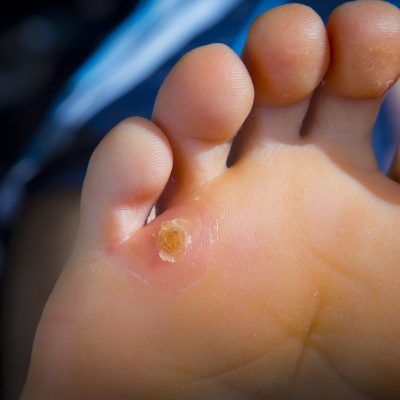 Calluses on foot