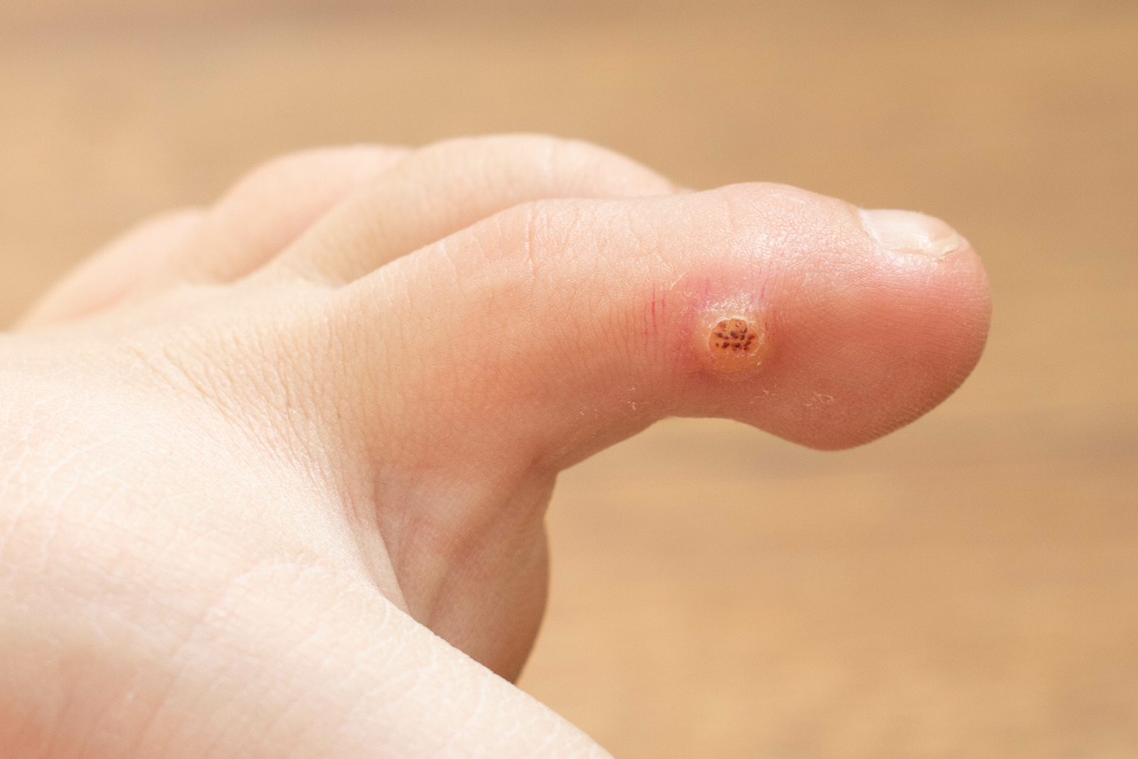 Papilloma wart on foot. How to Prevent & Treat Plantar Warts - Foot Care cancer de piele obraz