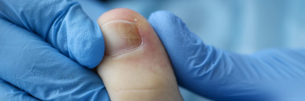 Doctor's hands in rubber gloves touch injured toenail in clinic closeup. Diagnosis and treatment of mycosis of feet concept.
