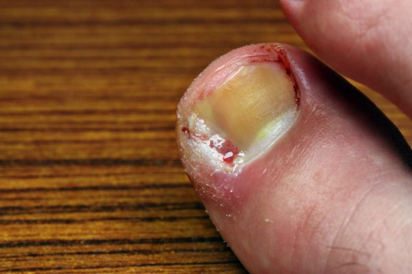 Ingrown toenail disease blood wound infection bacteria  finger  skin scab pus  toe liquid whitlow felon treatment swelling on a brown table background