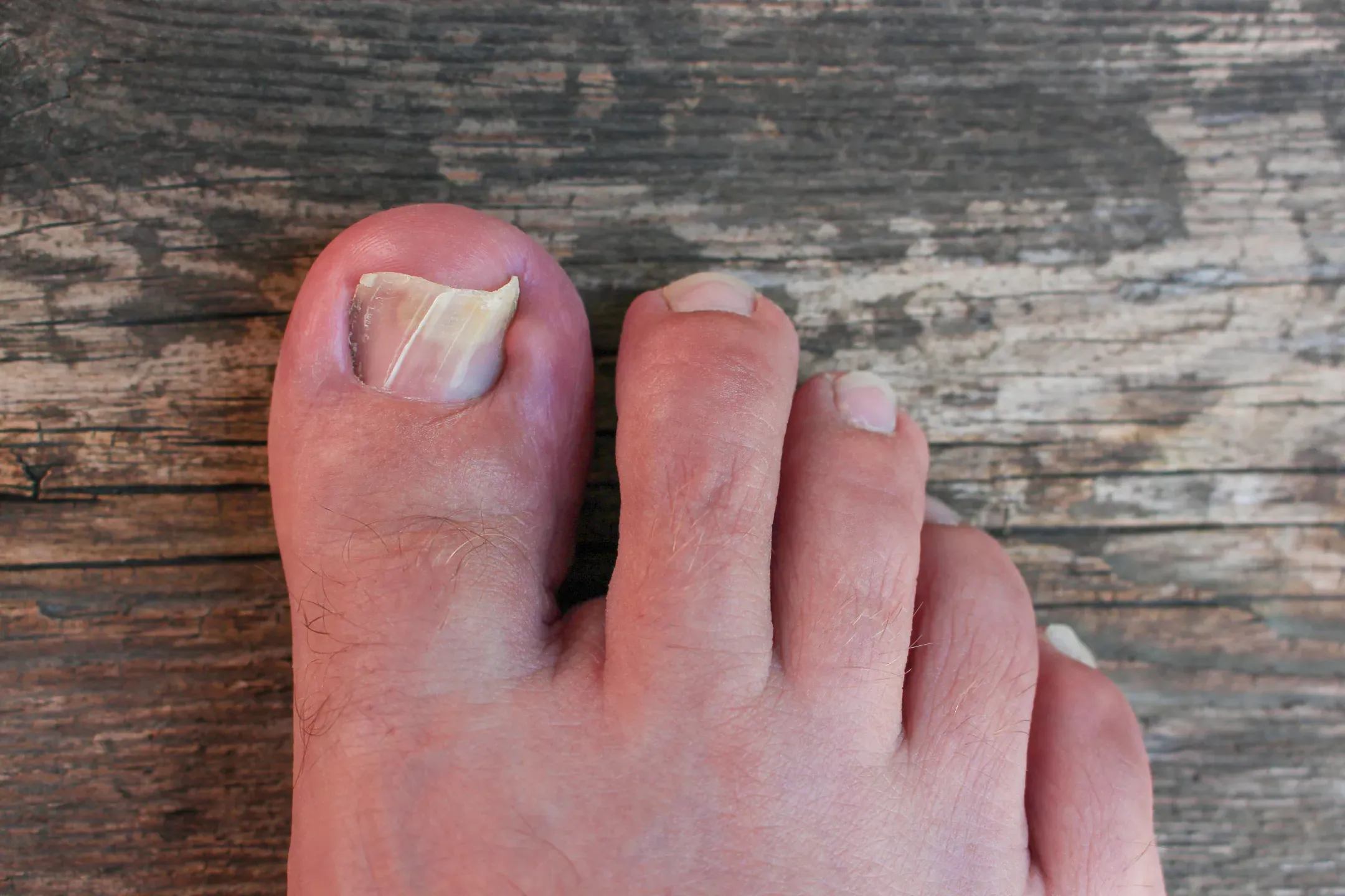 Ingrown Toenails: Home Care vs Nail Surgery 2 damaged toenail top view
