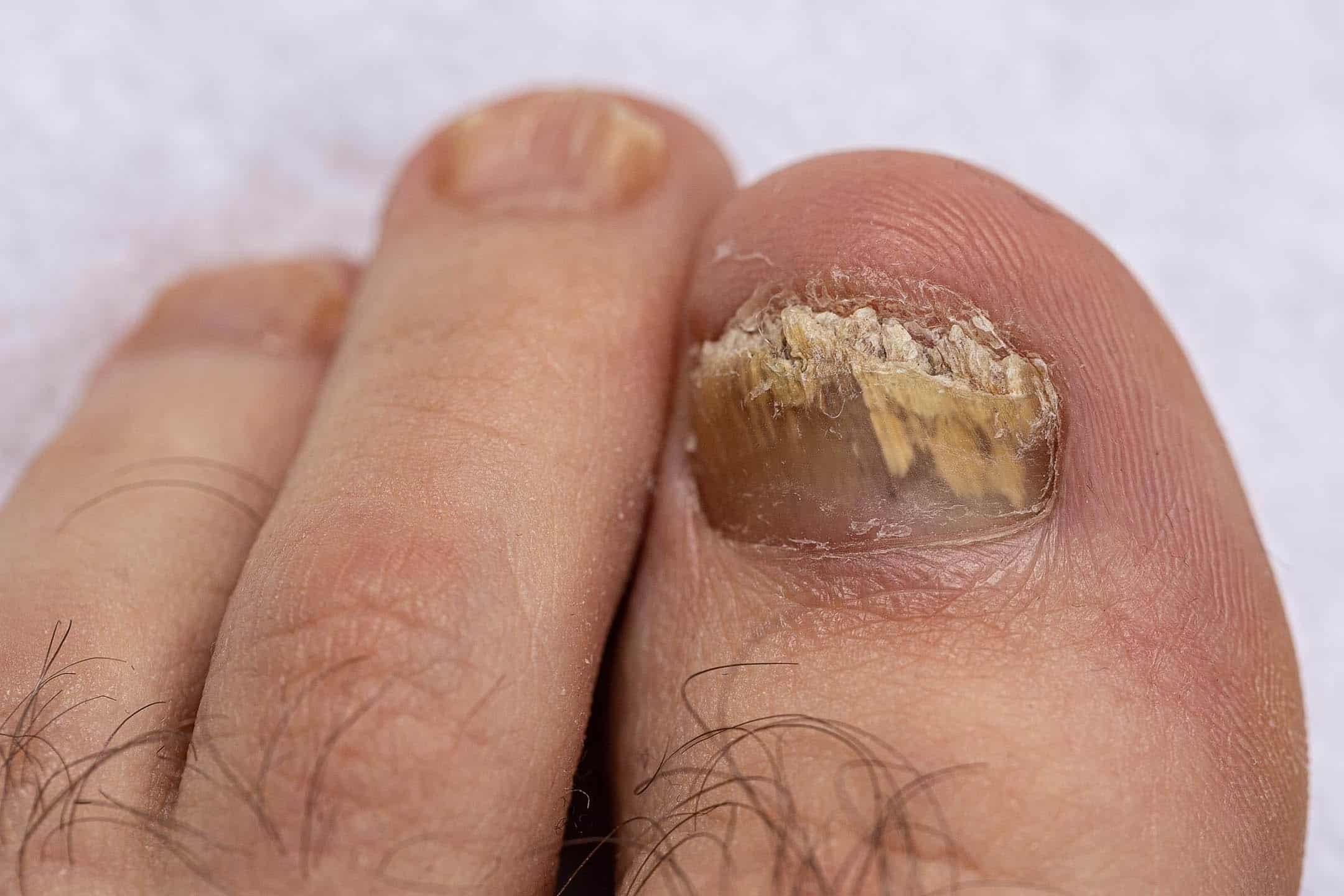 Fungal Nail Infections: Does Laser Treatment Actually Work? 1 fungail nail laser treatment