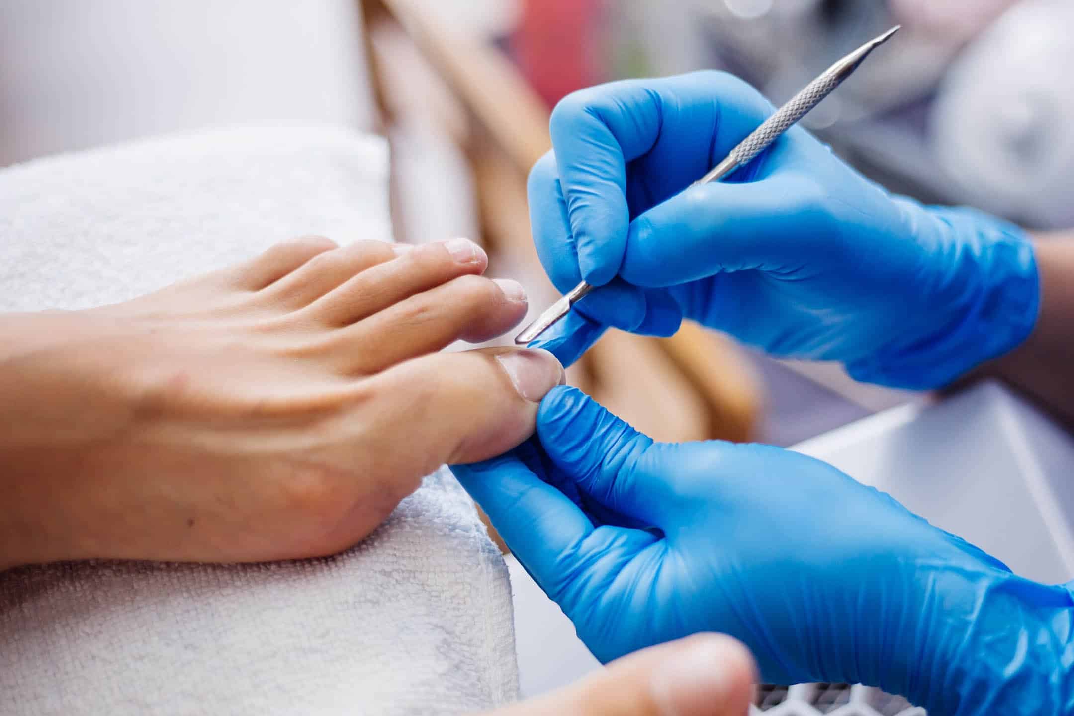 Fungal Nail Infections: Does Laser Treatment Actually Work? 2 fungal nail img1