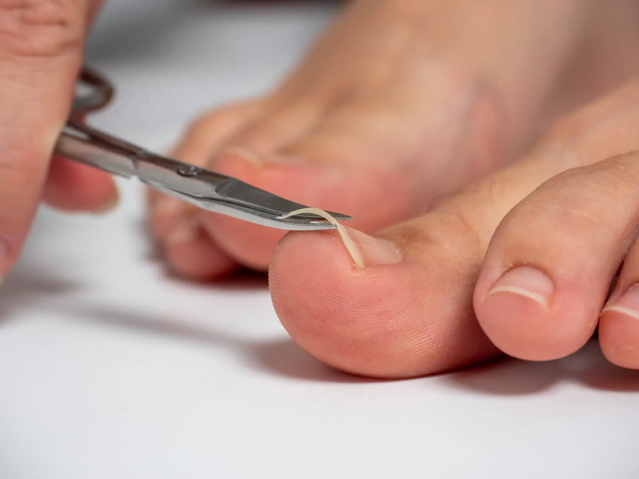 Ingrown Toenails: Home Care vs Nail Surgery 1 scissors cut nails big toe womans foot